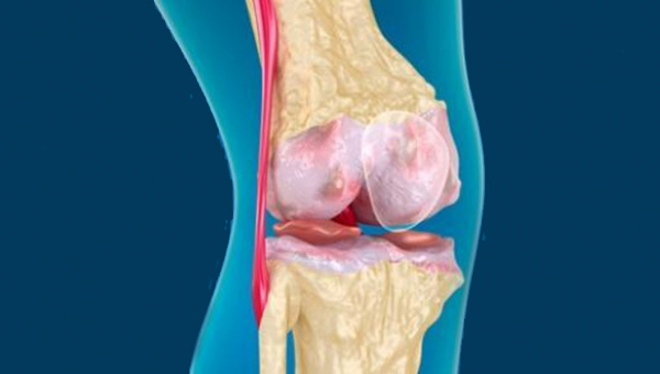 عملية استئصال الغضروف الهلالي في الهند