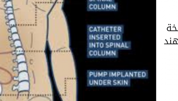 عملية زراعة مضخة باكلوفين في الهند