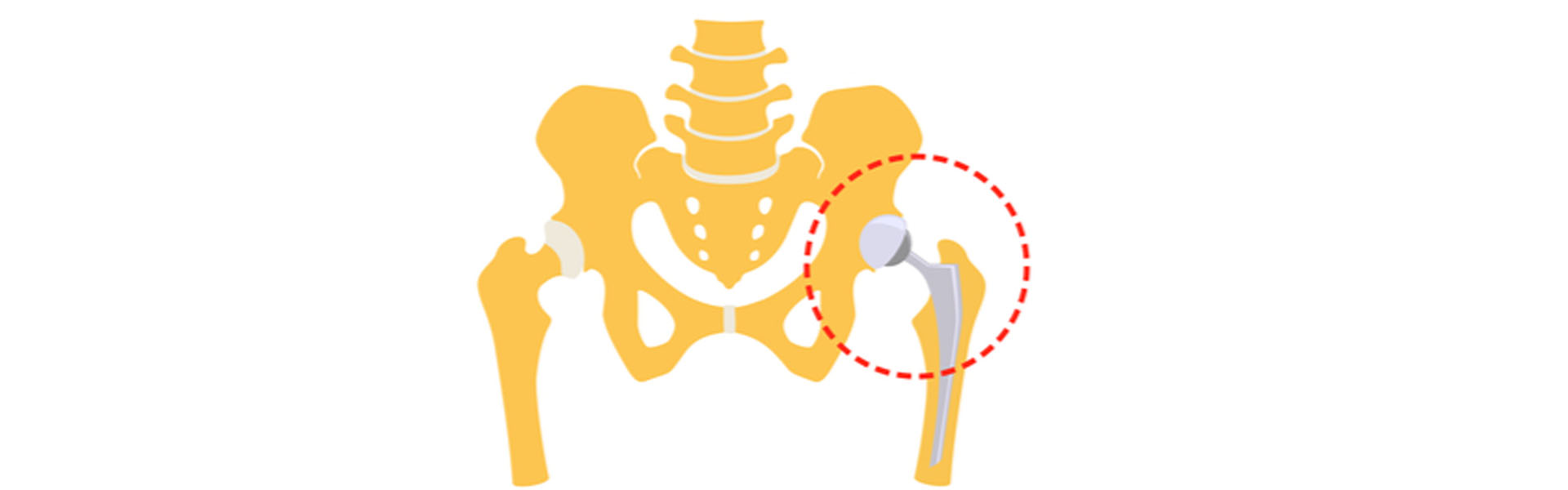 حقائق عن عملية تبديل الورك في الهند