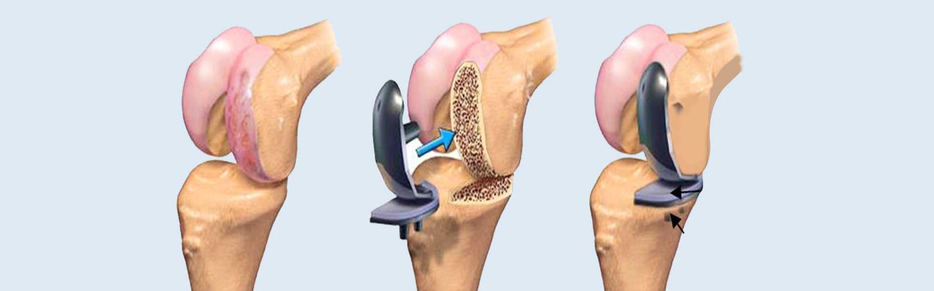  تعرف على عملية تبديل الركبة في الهند 