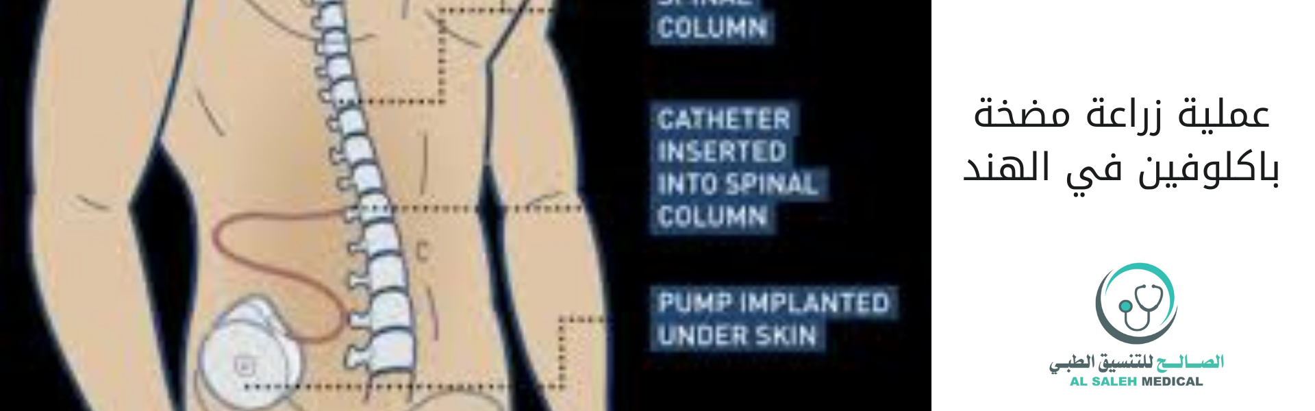 عملية زراعة مضخة باكلوفين في الهند