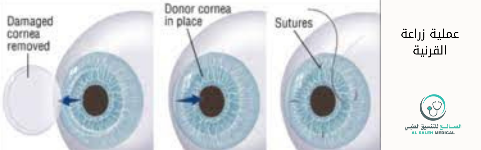  دليلك الشامل لعملية زراعة القرنية في الهند  