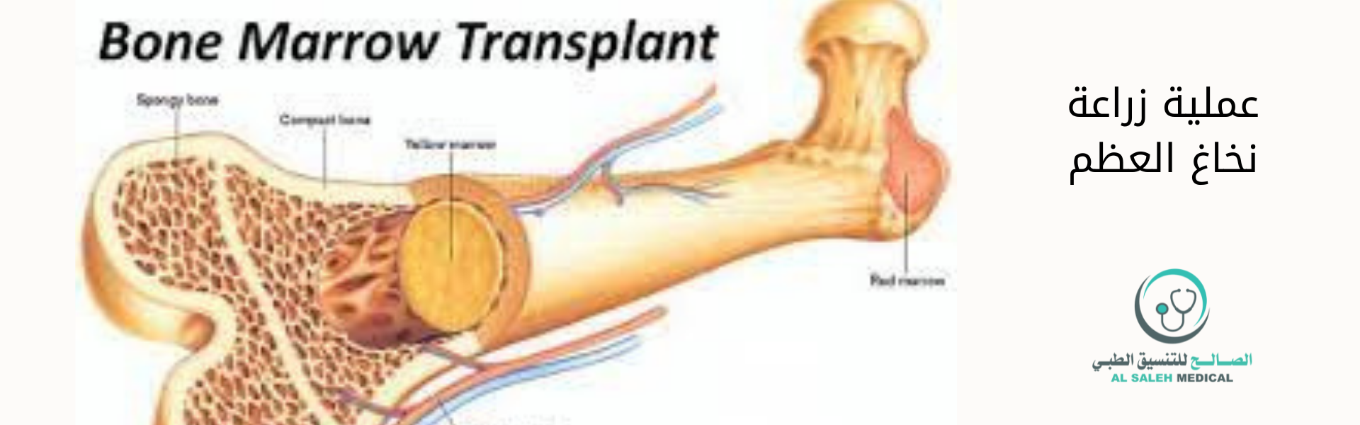 عملية زراعة نخاع العظم في الهند
